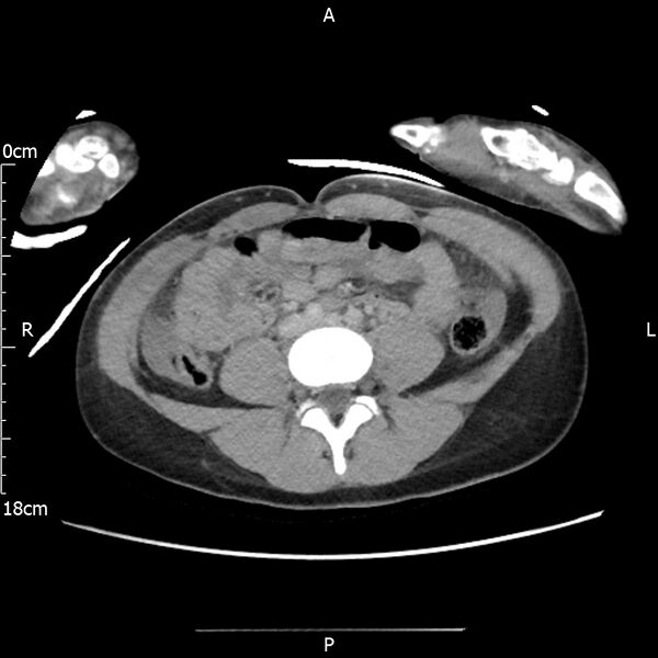 File:AAST grade IV kidney injury with CEUS follow-up (Radiopaedia 72353-82877 Axial C+ portal venous phase 44).jpg