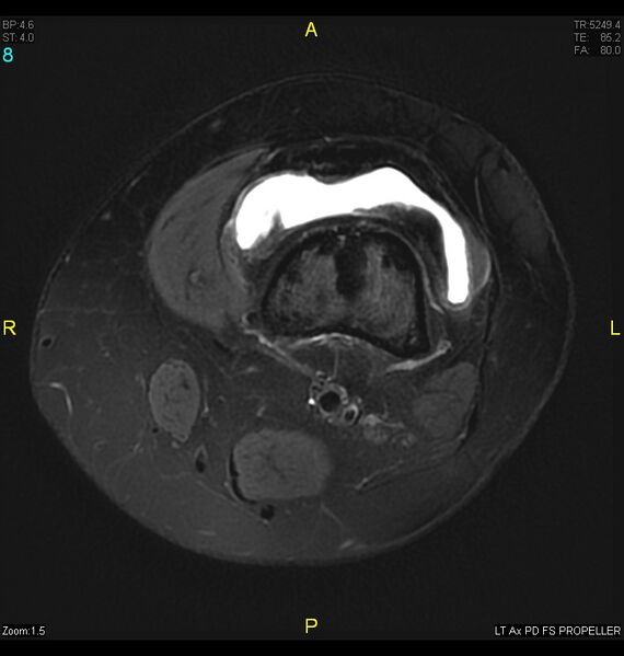 File:ACL mucoid degeration with cystic changes (Radiopaedia 48428-53341 Axial PD fat sat 5).jpg