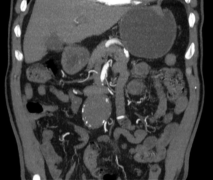 File:Abdominal aortic aneurysm (Radiopaedia 22421-22458 C 11).jpg