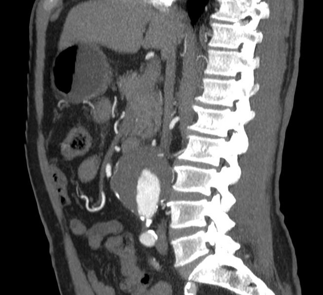File:Abdominal aortic aneurysm (Radiopaedia 22421-22458 D 17).jpg