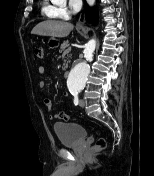 File:Abdominal aortic aneurysm (Radiopaedia 25855-26001 Sagittal C+ arterial phase 29).jpg