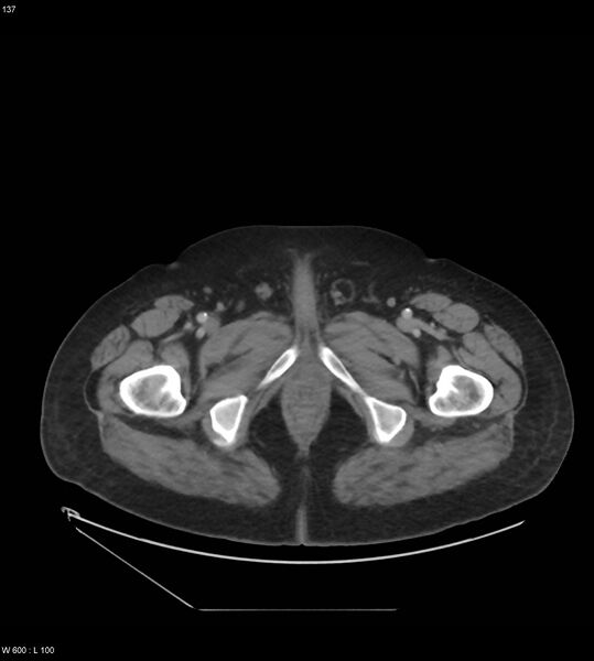 File:Abdominal aortic aneurysm with intramural hematoma then rupture (Radiopaedia 50278-55631 Axial C+ arterial phase 128).jpg