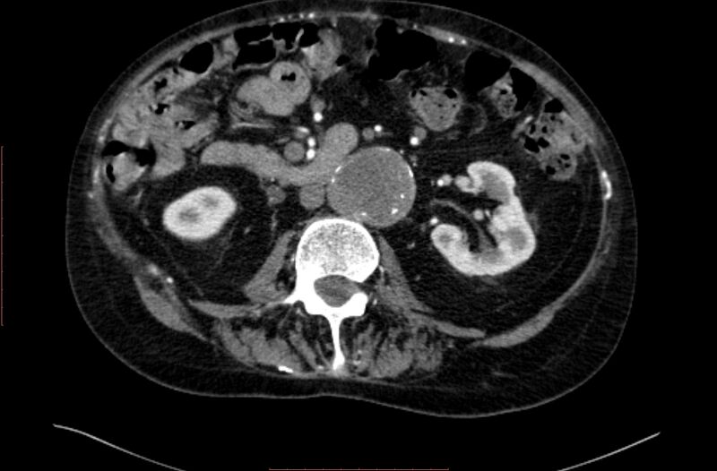 File:Abdominal aortic interposition tube graft and aneurysm thrombosis (Radiopaedia 71438-81857 Axial C+ arterial phase 73).jpg
