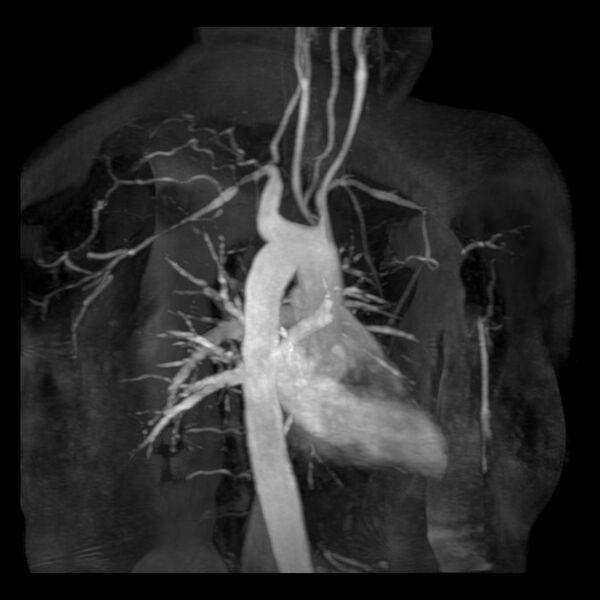File:Aberrant right subclavian artery with background Takayasu arteritis (Radiopaedia 21423-21363 MRA 9).jpg