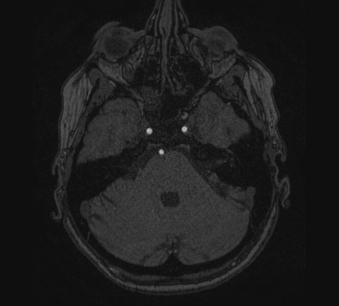 File:Accessory middle cerebral artery and ICA aneurysm (Radiopaedia 22656-22674 MRA 12).jpg