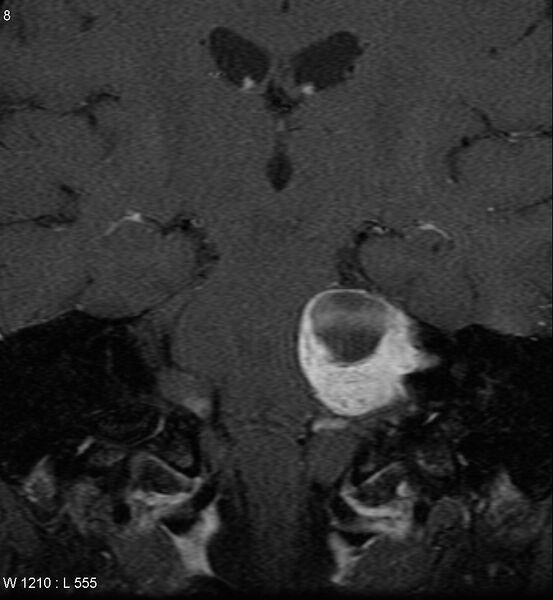 File:Acoustic schwannoma (large with cystic change) (Radiopaedia 5369-7130 Coronal T1 C+ fat sat 5).jpg