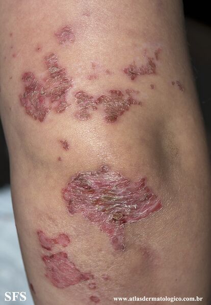 File:Acrodermatitis Enteropathica (Dermatology Atlas 46).jpg