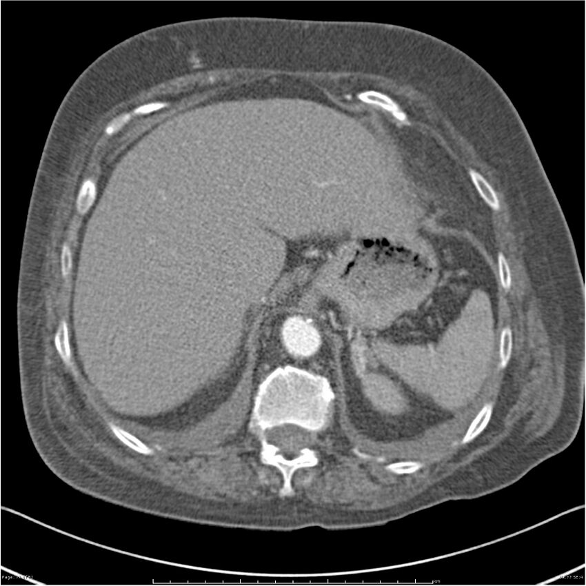 Acute-on-chronic pulmonary emboli (Radiopaedia 27925-28169 C+ CTPA 77).jpg