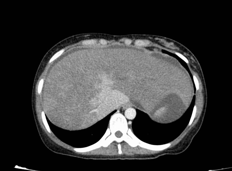 File:Acute Budd-Chiari syndrome (Radiopaedia 60858-68638 Axial C+ portal venous phase 39).jpg