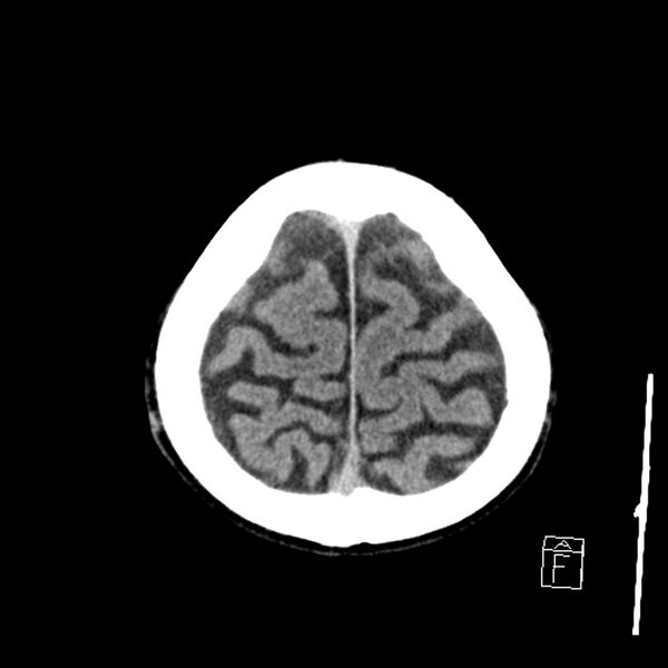 File:Acute P1 occlusion with PCA ischemia penumbra (CT perfusion) (Radiopaedia 72084-82586 Axial non-contrast 41).jpg