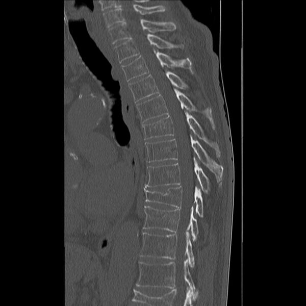 File:Acute and chronic vertebral compression fractures (Radiopaedia 31608-32494 Sagittal bone window 12).jpg