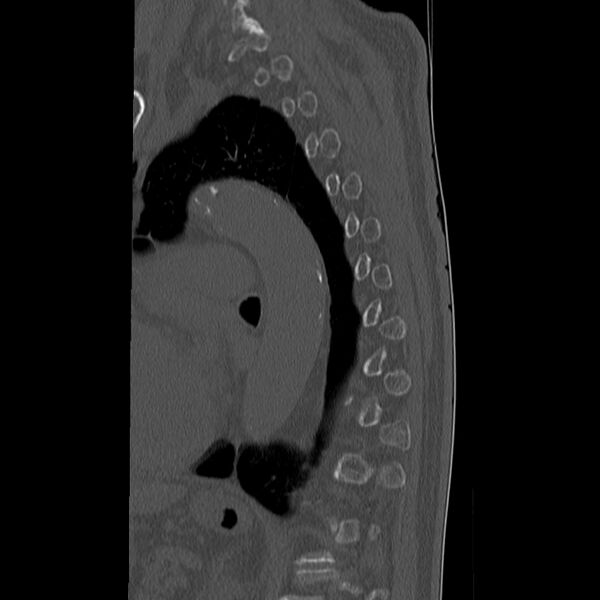 File:Acute and chronic vertebral compression fractures (Radiopaedia 31608-32494 Sagittal bone window 27).jpg