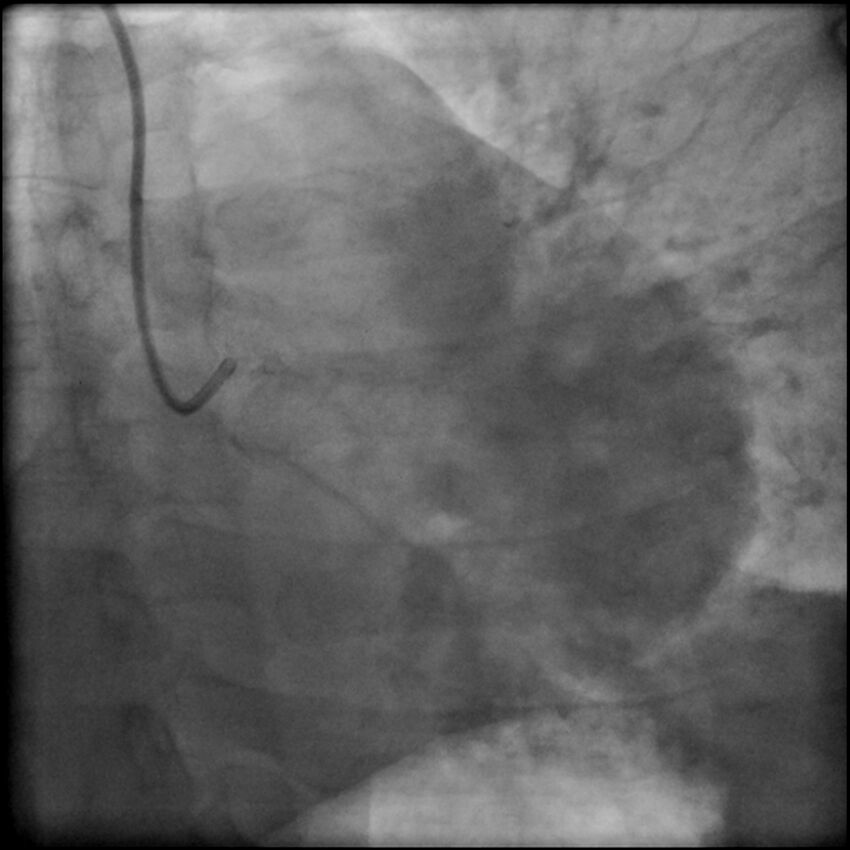 Acute anteroseptal myocardial infarction (Radiopaedia 68409-77946 LAO caudal (spider view) LAD and CX 11).jpg