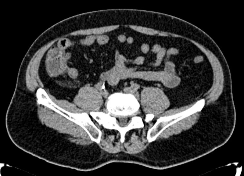 File:Acute appendicitis (Radiopaedia 13030-13091 Axial non-contrast 13).jpg