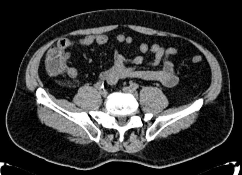 Acute appendicitis (Radiopaedia 13030-13091 Axial non-contrast 13).jpg