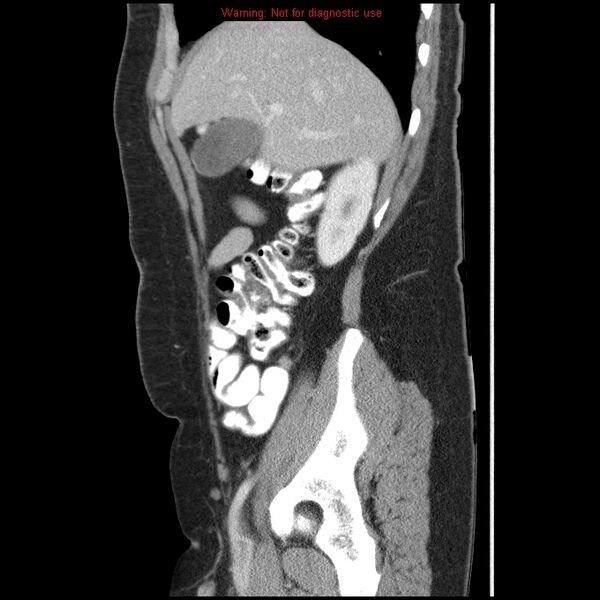 File:Acute appendicitis (Radiopaedia 7966-8812 B 9).jpg