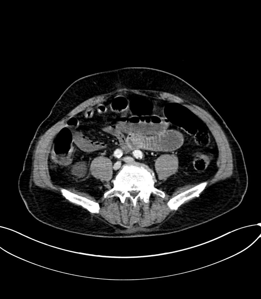Acute arterial mesenteric ischemia (Radiopaedia 78238-90828 Axial C+ portal venous phase 93).jpg