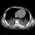Acute aspiration pneumonitis (Radiopaedia 33605-34703 Axial non-contrast 57).jpg