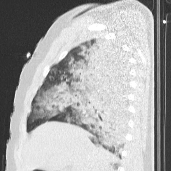 File:Acute aspiration pneumonitis (Radiopaedia 33605-34703 Sagittal lung window 29).jpg