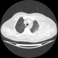 Acute heart failure (CT) (Radiopaedia 79835-93075 Axial lung window 10).png