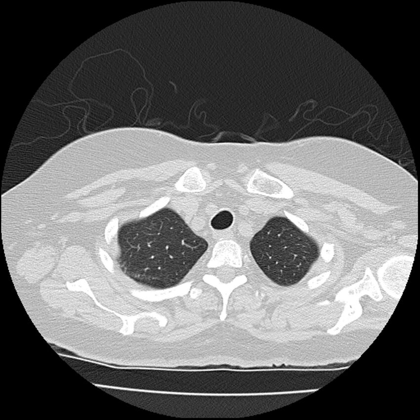Acute interstitial pneumonitis (Radiopaedia 45404-49452 Axial lung window 12).jpg