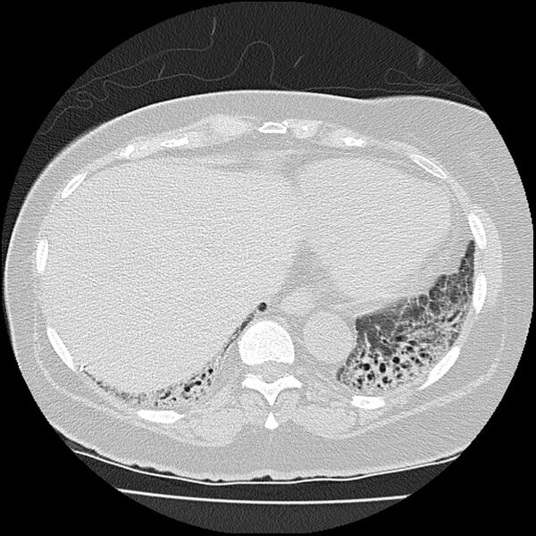 File:Acute interstitial pneumonitis (Radiopaedia 45404-49452 Axial lung window 74).jpg