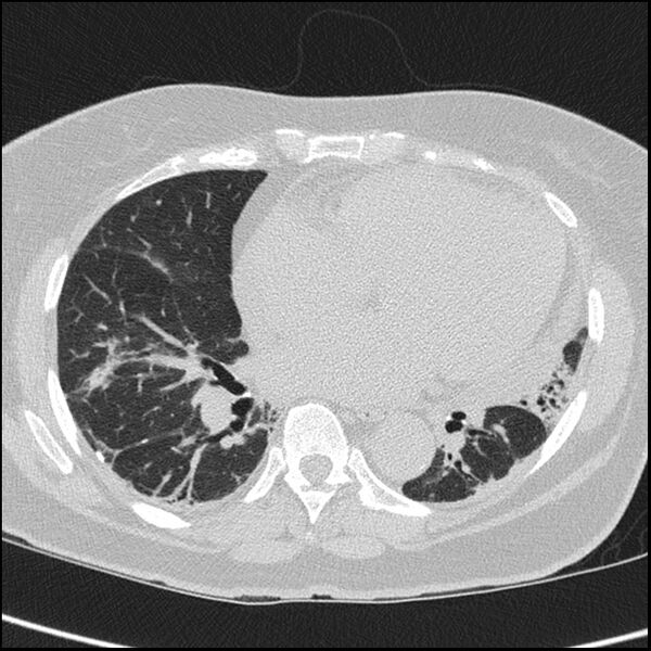 File:Acute interstitial pneumonitis (Radiopaedia 45404-49453 Axial lung window 52).jpg
