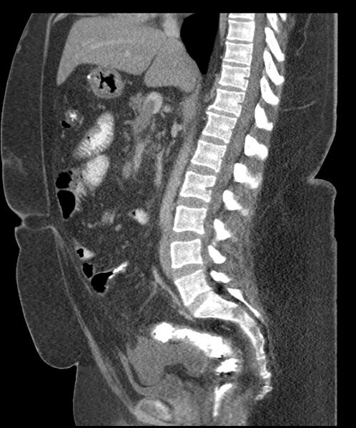 File:Acute mesenteric venous ischemia (Radiopaedia 46041-50383 Sagittal C+ portal venous phase 59).jpg
