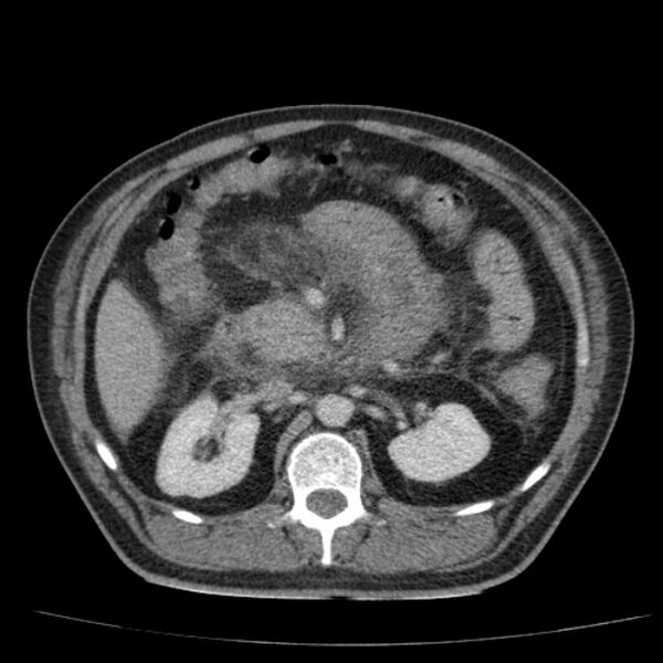 File:Acute pancreatitis (Radiopaedia 26663-26813 Axial C+ portal venous phase 34).jpg