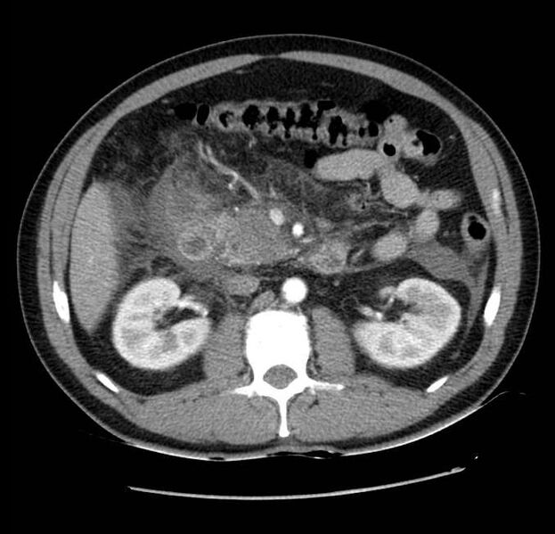 File:Acute pancreatitis - Balthazar E (Radiopaedia 23080-23110 Axial C+ arterial phase 29).jpg