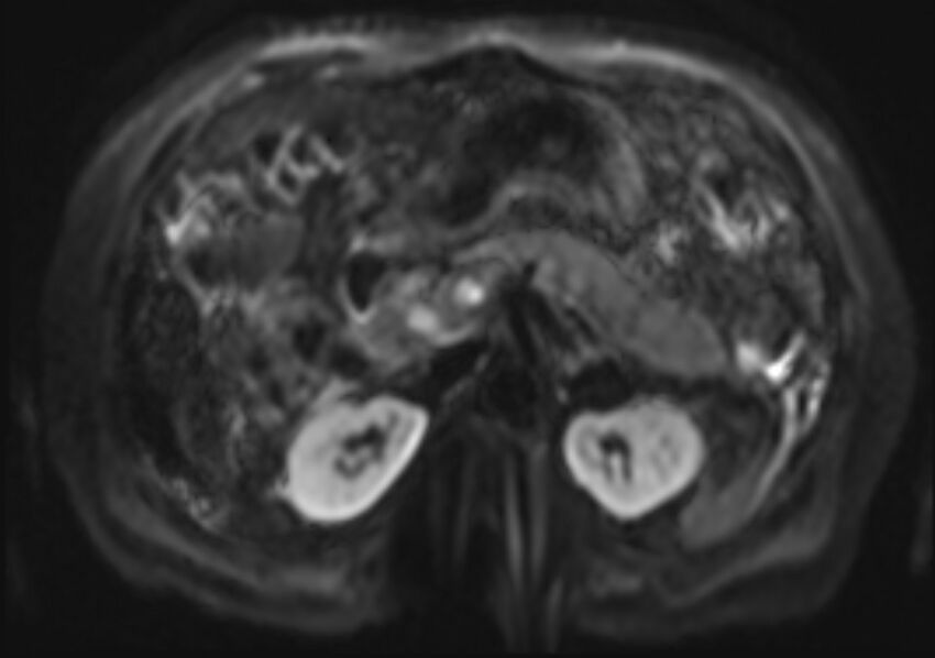 Acute portal vein thrombosis (Radiopaedia 73198-83925 Axial DWI 17).jpg
