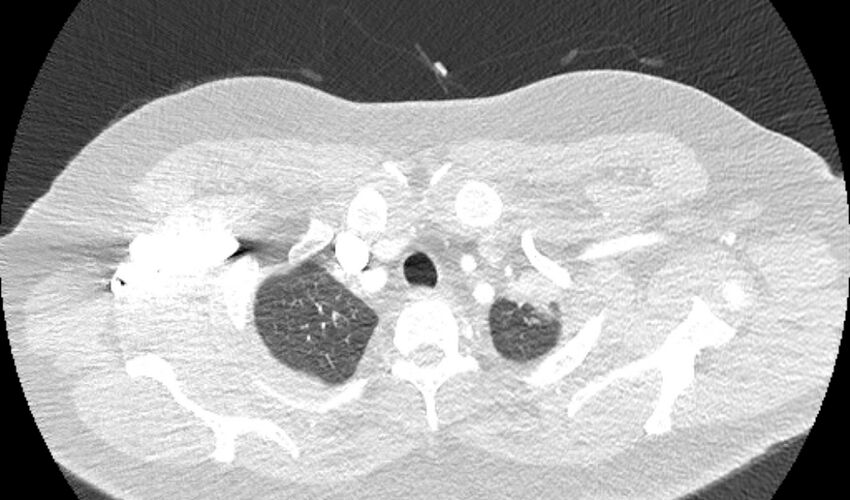 Acute pulmonary embolism with pulmonary infarcts (Radiopaedia 77688-89908 Axial lung window 2).jpg