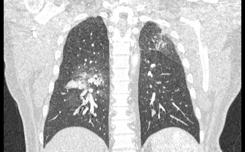 File:Acute pulmonary embolism with pulmonary infarcts (Radiopaedia 77688-89908 Coronal lung window 73).jpg