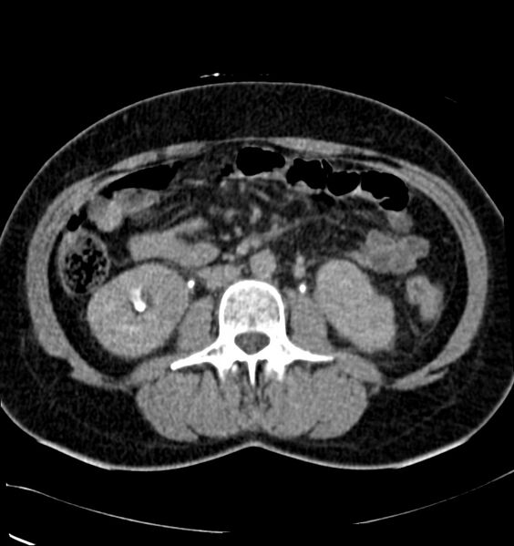 File:Acute pyelonephritis (Radiopaedia 40264-42816 Axial renal excretory phase 14).jpg