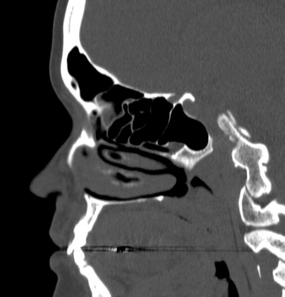 File:Acute sinusitis (Radiopaedia 22419-22455 Sagittal non-contrast 16).jpg