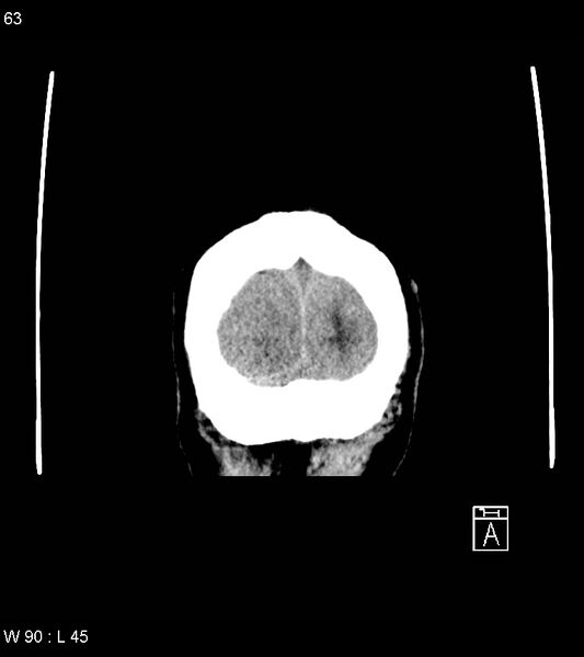 File:Acute subdural hematoma with myelofibrosis (Radiopaedia 52582-58494 Coronal non-contrast 54).jpg