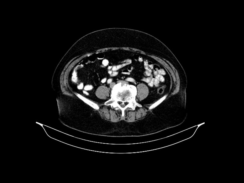 File:Adenocarcinoma of pancreas with hepatic metastasis (Radiopaedia 64332-73122 Axial C+ portal venous phase 69).jpg