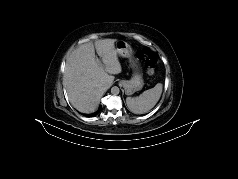 File:Adenocarcinoma of pancreas with hepatic metastasis (Radiopaedia 64332-73122 Axial non-contrast 23).jpg