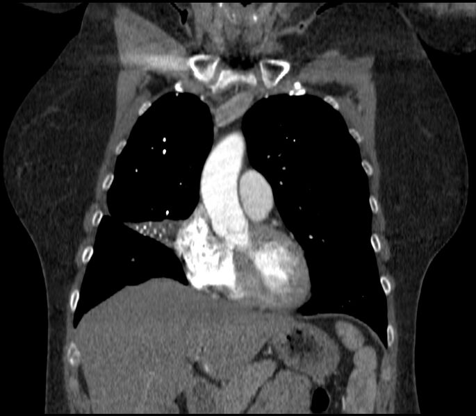 File:Adenocarcinoma of the lung (Radiopaedia 44205-47803 Coronal C+ portal venous phase 28).jpg