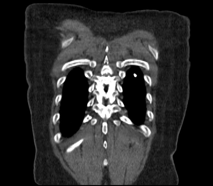 File:Adenocarcinoma of the lung (Radiopaedia 44205-47803 Coronal C+ portal venous phase 91).jpg