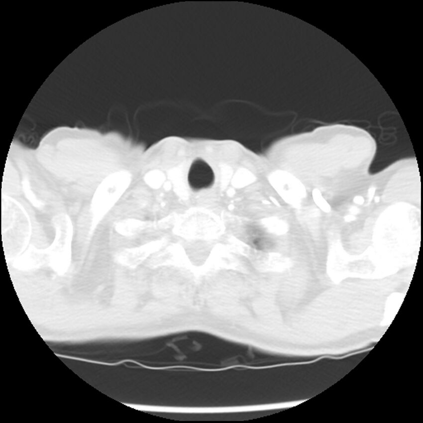 Adenocarcinoma of the lung - micropapillary predominant (Radiopaedia 42446-45563 Axial lung window 3).jpg