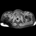 Adenomyoma of the uterus (huge) (Radiopaedia 9870-10438 Axial T1 fat sat 7).jpg