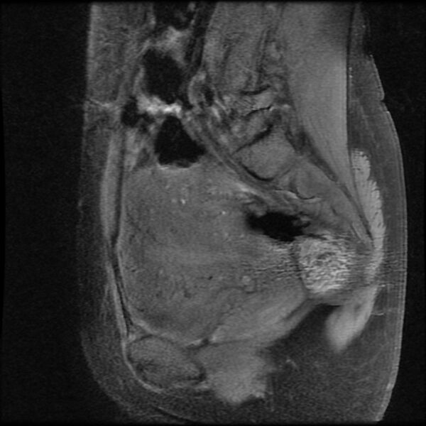 File:Adenomyosis on MRI (Radiopaedia 29328-29780 Sagittal T1 fat sat 12).jpg