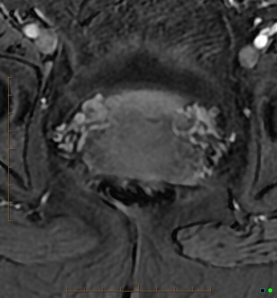 File:Adenomyosis uterus with hematometra (Radiopaedia 45779-50011 Axial T1 C+ fat sat 48).jpg