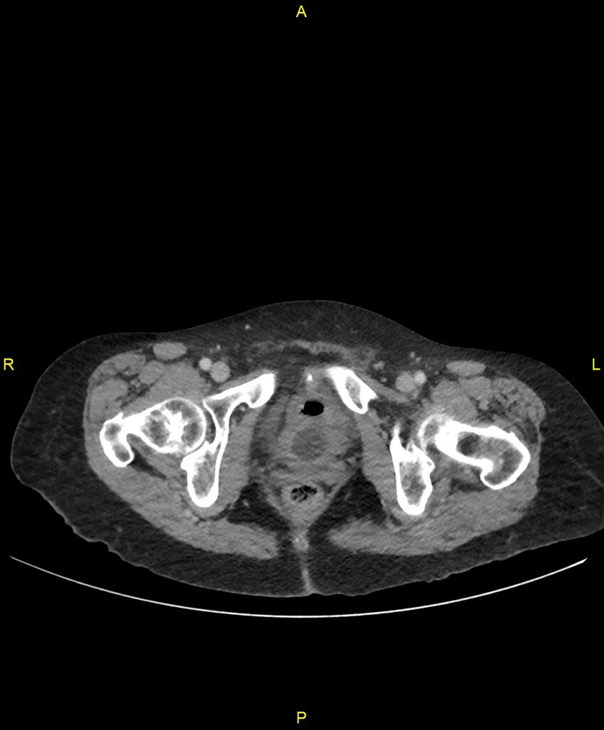 Adhesional small bowel obstruction (Radiopaedia 85402-101024 Axial C+ portal venous phase 283).jpg