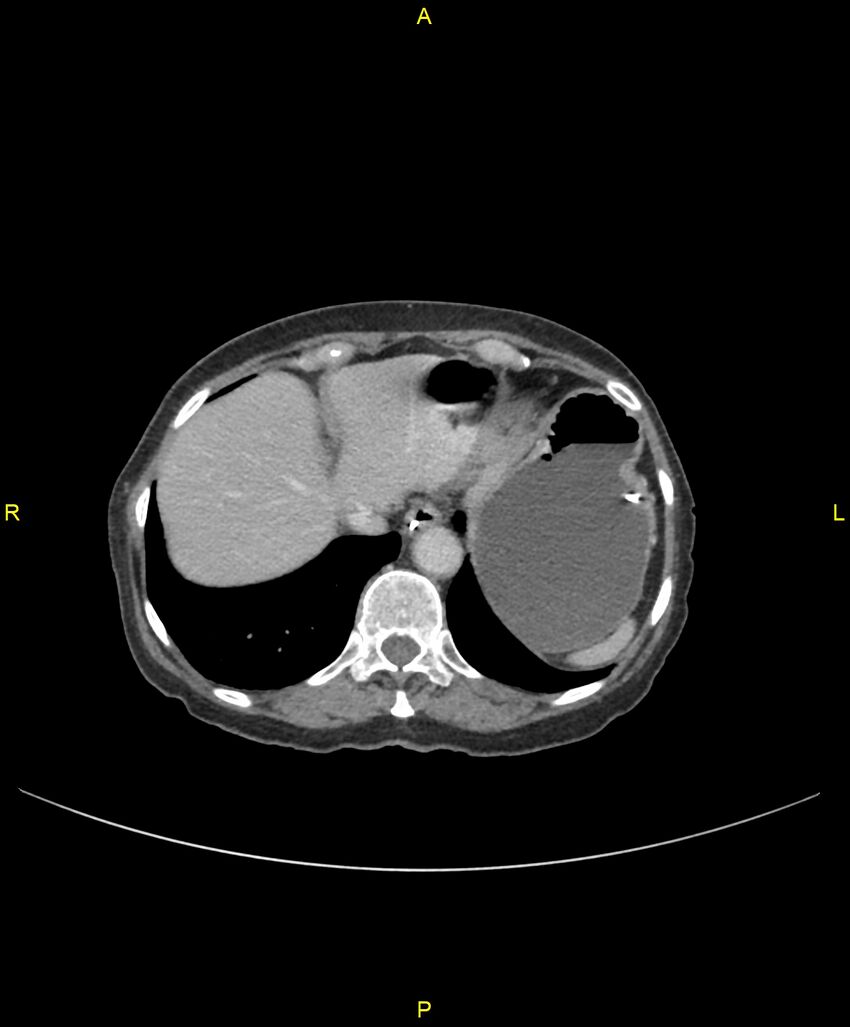 Adhesional small bowel obstruction (Radiopaedia 85402-101024 Axial C+ portal venous phase 40).jpg