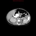 Adrenal hemorrhage (Radiopaedia 9390-10077 Axial C+ portal venous phase 15).jpg