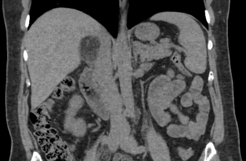 Adrenal myelolipoma (Radiopaedia 65240-74253 Coronal non-contrast 17).jpg