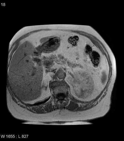 File:Adrenal myelolipoma (Radiopaedia 6765-7961 Axial T1 in-phase 18).jpg