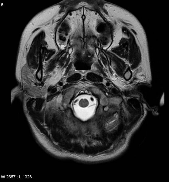 File:Aicardi syndrome (Radiopaedia 5353-7117 Axial T2 1).jpg